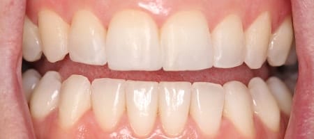 After Invisalign Treatment Reading Smiles