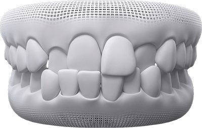 cross-bite teeth example 