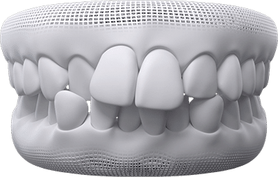 crowded teeth example