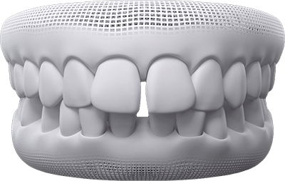 spaced and gapped teeth example