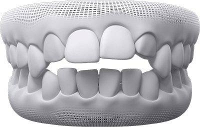 open-bite teeth example