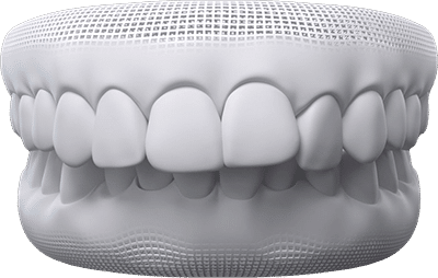 Overbite/overjet teeth example