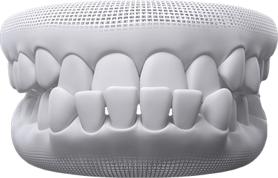 Underbite teeth example