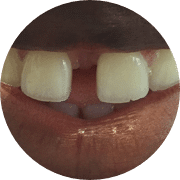 Gaps between teeth