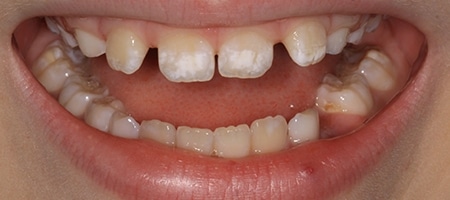 Before Invisalign Treatment Reading Smiles 