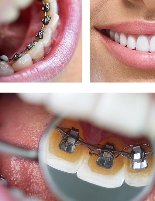 Metal Braces - Traditional Braces Cost - Kingston Orthodontics