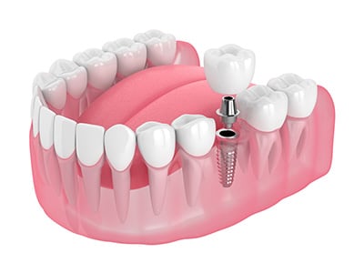 dental implant Milton Keynes