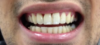 Before and After Invisalign Treatment Kingston