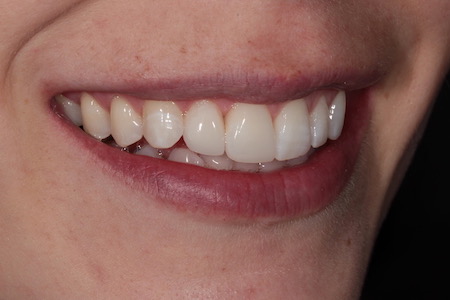 After Invisalign Treatment Reading Smiles