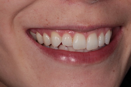 Before Invisalign Treatment Reading Smiles