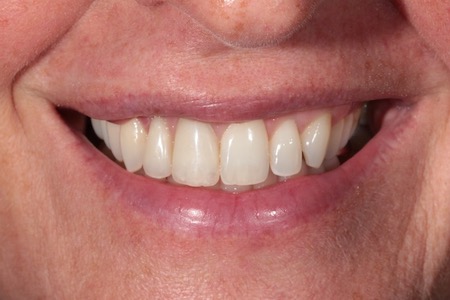 Before and After Invisalign Treatment Kingston