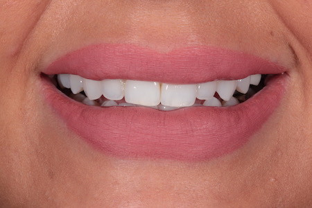 Before Invisalign Treatment Reading Smiles