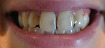Before and After Invisalign Treatment Kingston