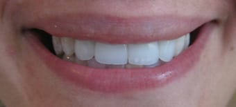 Before and After Invisalign Treatment Kingston