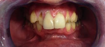 Before and After Invisalign Treatment Kingston