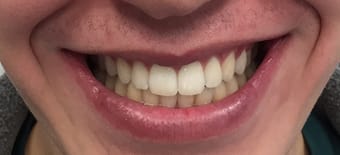Before and After Invisalign Treatment Kingston