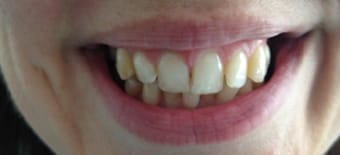Before and After Invisalign Treatment Kingston