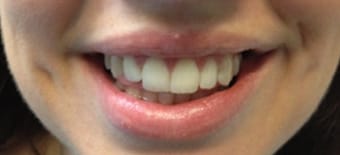 Before and After Invisalign Treatment Kingston