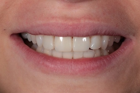 Before and After Invisalign Treatment Kingston