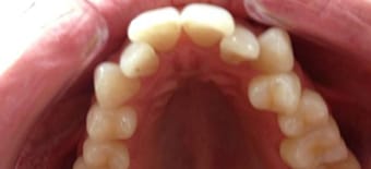 Before and After Invisalign Treatment Kingston
