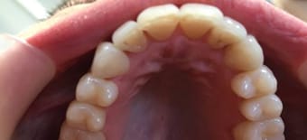 Before and After Invisalign Treatment Kingston