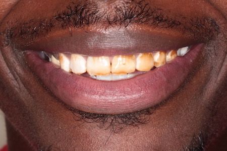 Before and After Invisalign Treatment Kingston