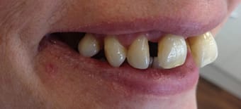 Before and After Invisalign Treatment Kingston