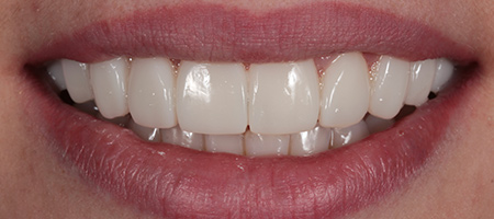After Invisalign Treatment Reading Smiles