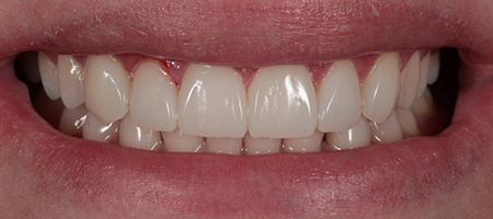 After Invisalign Treatment Reading Smiles