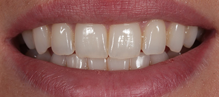 Composite Bonding Cases