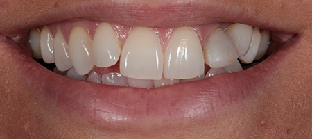 Composite Bonding Cases
