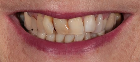 Composite Bonding Cases