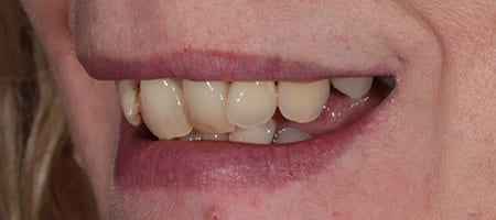 Composite Bonding Cases