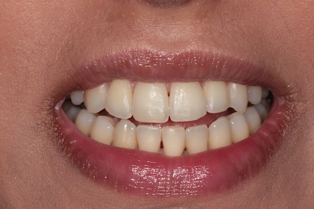 Before Invisalign Treatment Reading Smiles