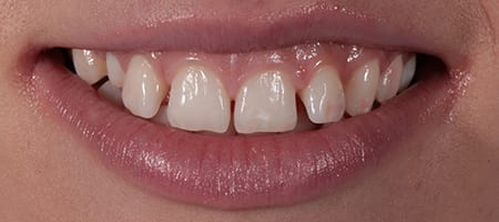 Composite Bonding Cases