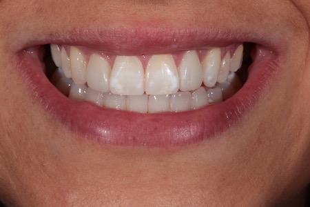 After Invisalign Treatment Reading Smiles