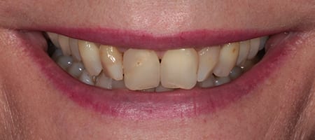 Composite Bonding Cases
