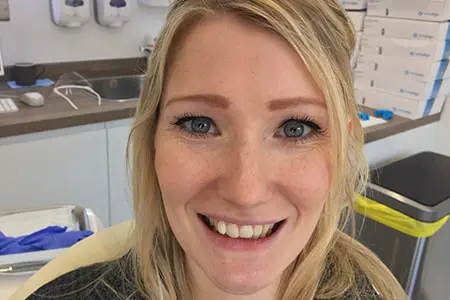 Before and After Invisalign Treatment Kingston Before and After Invisalign Treatment Kingston