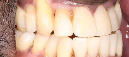 Before and After Invisalign Treatment Kingston Before and After Invisalign Treatment Kingston