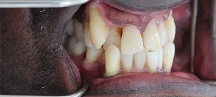 Before and After Invisalign Treatment Kingston Before and After Invisalign Treatment Kingston