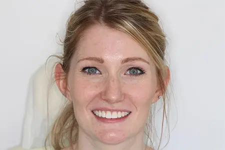 Before and After Invisalign Treatment Kingston Before and After Invisalign Treatment Kingston