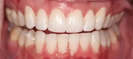 Before and After Invisalign Treatment Kingston Before and After Invisalign Treatment Kingston