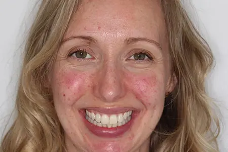 Before and After Invisalign Treatment Kingston Before and After Invisalign Treatment Kingston