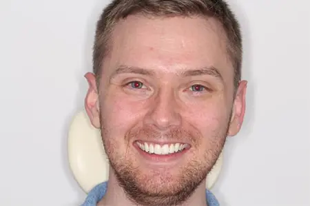 Before and After Invisalign Treatment Kingston Before and After Invisalign Treatment Kingston