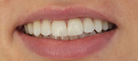 Before and After Invisalign Treatment Kingston Before and After Invisalign Treatment Kingston