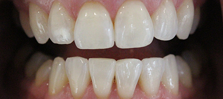Before and After Invisalign Treatment Kingston Before and After Invisalign Treatment Kingston