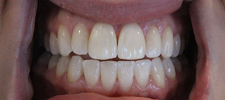 Before and After Invisalign Treatment Kingston Before and After Invisalign Treatment Kingston