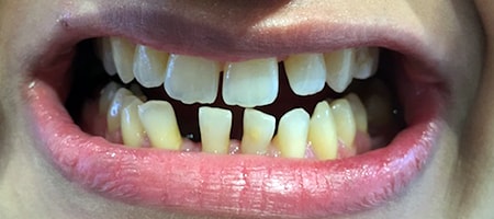 Before and After Invisalign Treatment Kingston Before and After Invisalign Treatment Kingston