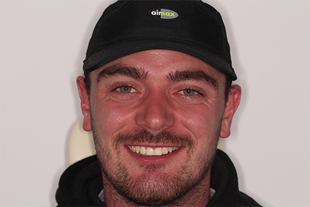 Before and After Invisalign Treatment Kingston Before and After Invisalign Treatment Kingston