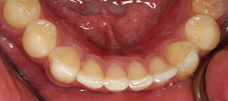 Before and After Invisalign Treatment Kingston Before and After Invisalign Treatment Kingston